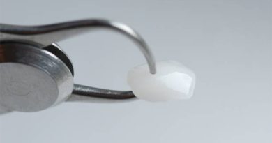 ทันตกรรมวีเนียร์ราคาดี