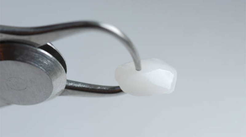 ทันตกรรมวีเนียร์ราคาดี