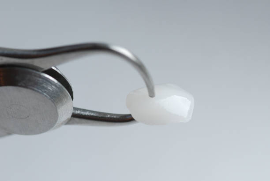 ทันตกรรมวีเนียร์ราคาดีที่เชียงใหม่