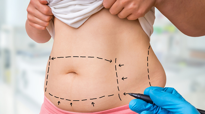 ทำโปรแกรมดูดไขมันหน้าท้องที่ไหนดี