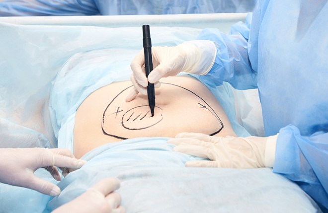 ปัจจัยเลือกคลินิกทำโปรแกรมดูดไขมันหน้าท้อง